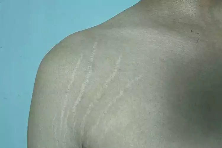 traitement-vergetures-efficace​